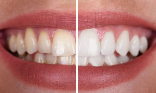 Close-up Of A Smiling Woman's Teeth Before And After Whitening