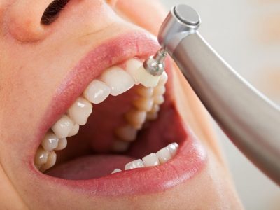 Professional dental cleaning, female patient's beautiful denture