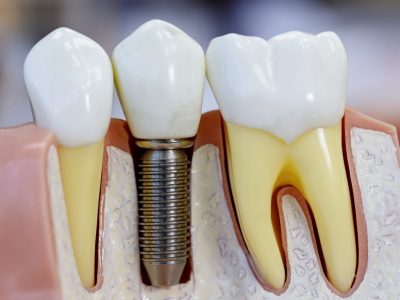 Close up of dental model with implantation