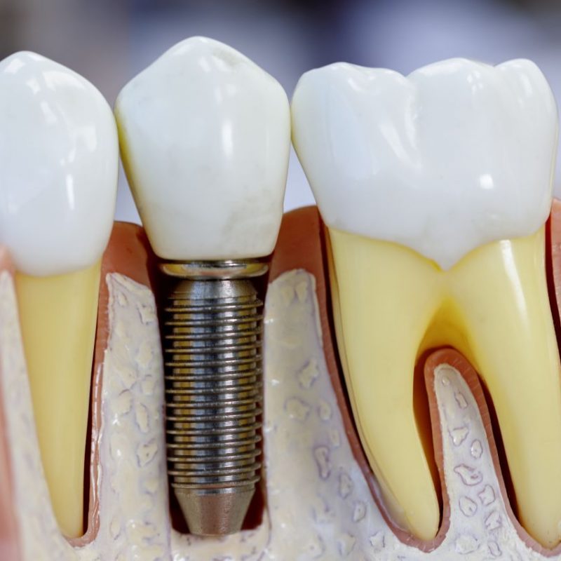 Close up of dental model with implantation